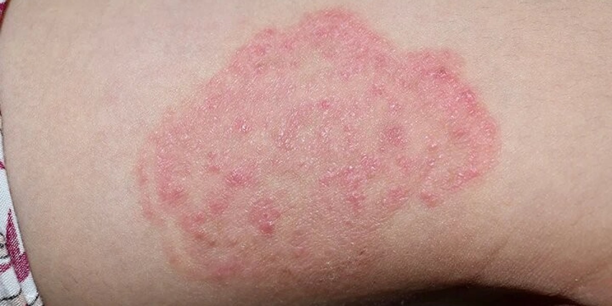 How to treat a bacterial skin infection