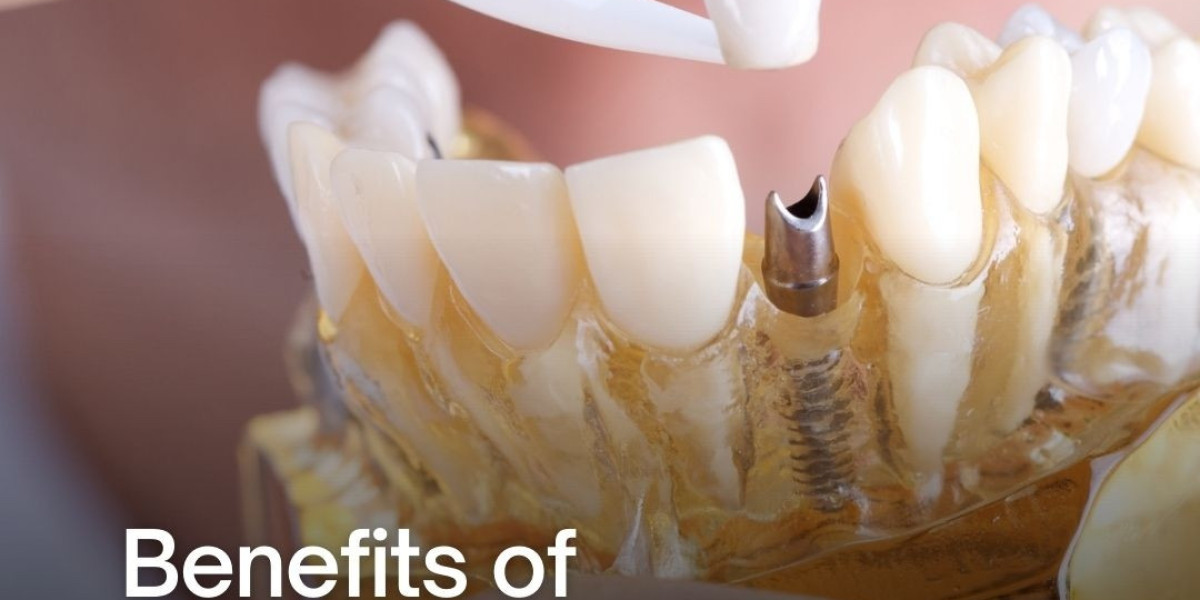 Transform Your Smile with Dental Implants at Molldrem Family Dentistry