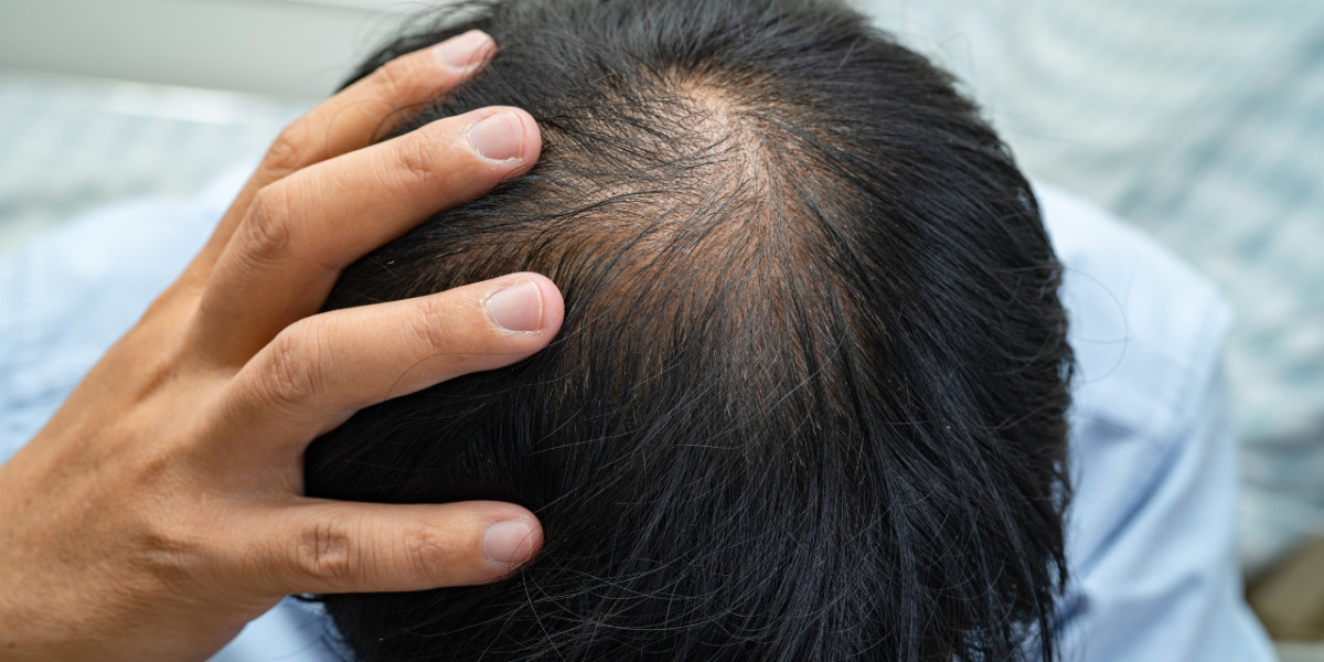No Shave FUE: Ideal Candidates and Success Rates