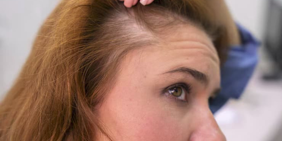 From PRP to Transplants: Hair Loss Treatment Options in London