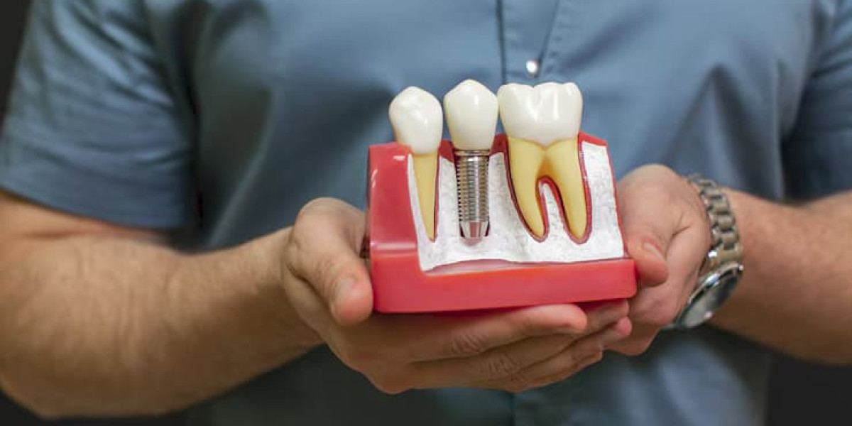 Santa Monica Dental Implants That Look & Feel Natural
